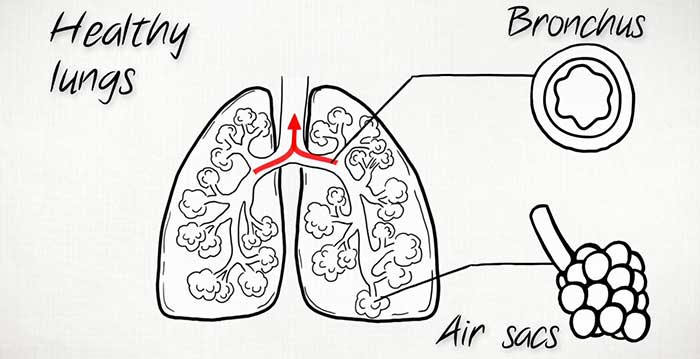 COPD